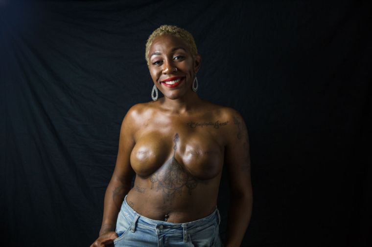 Myth: You can’t get cancer after a mastectomy