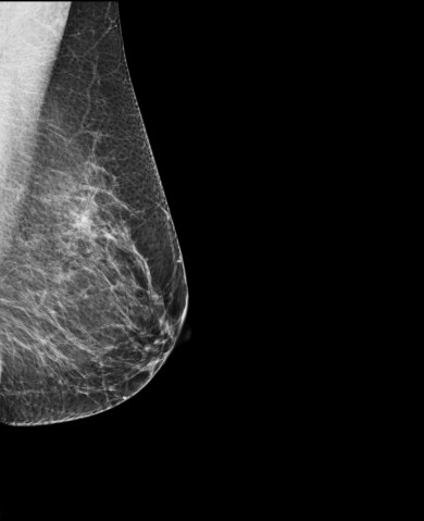 Breast Mammography, X-ray of woman's breast for early identification of breast cancer